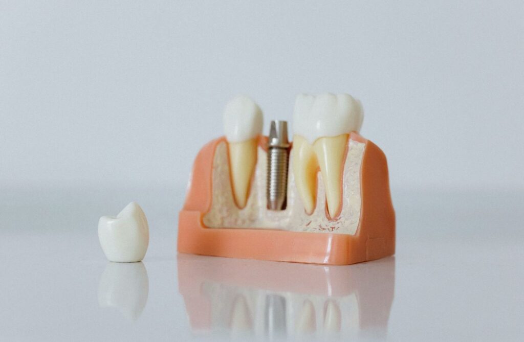Model implantu zęba z łącznikiem i koroną